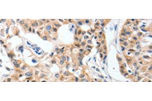 Immunohistochemistry of paraffin-embedded Human lung cancer tissue using P2RY6 Polyclonal Antibody at dilution of 1:40(x200) (P2RY6 Antikörper)