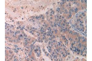 DAB staining on IHC-P; Samples: Human Breast cancer Tissue (SCUBE3 Antikörper  (AA 807-993))