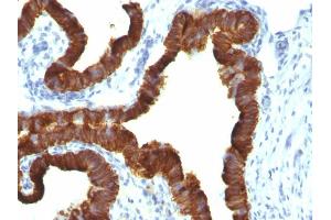 Formalin-fixed, paraffin-embedded human Ovarian Carcinoma stained with Cytokeratin 7 Mouse Monoclonal Antibody (KRT7/1198). (Cytokeratin 7 Antikörper)