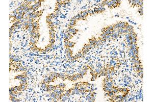 ABIN6265433 and ABIN6276580 at 1/100 staining Human prostate cancer by IHC-P.