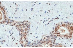 Immunohistochemistry of paraffin-embedded Human breast cancer using Phospho-AKT(S473) Polyclonal Antibody at dilution of 1:200 (40x lens). (AKT1 Antikörper  (pSer473))