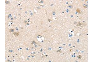 The image on the left is immunohistochemistry of paraffin-embedded Human brain tissue using ABIN7192395(SLC16A11 Antibody) at dilution 1/25, on the right is treated with synthetic peptide. (SLC16A11 Antikörper)