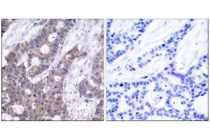 Immunohistochemical analysis of paraffin-embedded human breast carcinoma tissue, using Stathmin 1 (phospho-Ser15) antibody (E011234). (Stathmin 1 Antikörper  (pSer15))