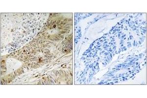 Immunohistochemistry analysis of paraffin-embedded human colon carcinoma, using ATRIP (Phospho-Ser224) Antibody. (ATRIP Antikörper  (pSer224))