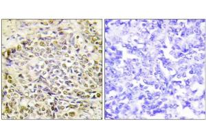 Immunohistochemistry analysis of paraffin-embedded human lung carcinoma tissue using IRX2 antibody. (IRX2 Antikörper  (Internal Region))