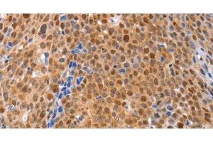 Immunohistochemistry of paraffin-embedded Human ovarian cancer using MKP-2 Polyclonal Antibody at dilution of 1:30 (DUSP4 Antikörper)