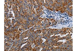 The image on the left is immunohistochemistry of paraffin-embedded Human ovarian cancer tissue using ABIN7192612(SPAG1 Antibody) at dilution 1/25, on the right is treated with synthetic peptide. (SPAG1 Antikörper)