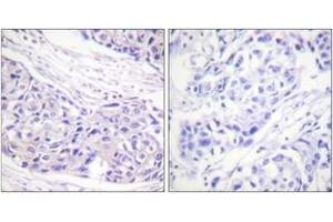 Immunohistochemistry analysis of paraffin-embedded human breast carcinoma tissue, using p90 RSK (Ab-359/363) Antibody. (RPS6KA3 Antikörper  (AA 331-380))