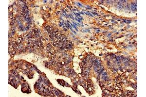 Immunohistochemistry of paraffin-embedded human colon cancer using ABIN7147936 at dilution of 1:100 (CLASP2 Antikörper  (AA 226-381))
