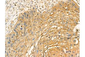 ABIN7094517 and ABIN7098566 at 1/100 staining Human esophageal cancer by IHC-P. (Golgi Integral Membrane Protein 4 (GOLIM4) (Internal Region) Antikörper)