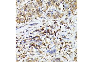Immunohistochemistry of paraffin-embedded human esophageal cancer using ASC/TMS1 Rabbit pAb (ABIN7269756) at dilution of 1:200 (40x lens). (PYCARD Antikörper)
