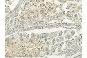 ABIN6257324 and ABIN6273467 at 1/100 staining human lung squamous cell carcinoma by IHC-P. (MLF1IP Antikörper  (N-Term))