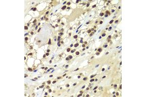Immunohistochemistry of paraffin-embedded human kidney cancer using PRKDC antibody (ABIN5975861) at dilution of 1/100 (40x lens). (PRKDC Antikörper)