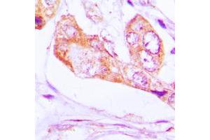Immunohistochemical analysis of PNPT1 staining in human lung cancer formalin fixed paraffin embedded tissue section. (PNPT1 Antikörper  (C-Term))