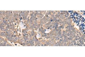 Immunohistochemistry of paraffin-embedded Human thyroid cancer tissue using NCAPH Polyclonal Antibody at dilution of 1:45(x200) (NCAPH Antikörper)