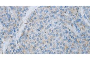 Immunohistochemistry of paraffin-embedded Human liver cancer using MMP25 Polyclonal Antibody at dilution of 1:80