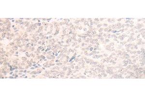 Immunohistochemistry of paraffin-embedded Human ovarian cancer tissue using EME2 Polyclonal Antibody at dilution of 1:40(x200) (EME2 Antikörper)