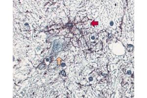 Formalin-fixed, paraffin embedded section of human brain stained for GFAP (clone 4A11, ABIN967499) using a DAB chromogen and hematoxylin counterstain. (GFAP Antikörper)