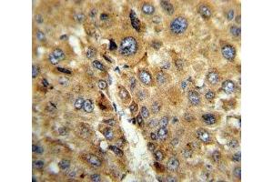 IHC analysis of FFPE human hepatocarcinoma stained with TAT antibody (Tat (AA 279-306) Antikörper)