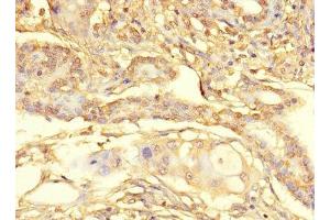 Immunohistochemistry of paraffin-embedded human pancreatic cancer using ABIN7166432 at dilution of 1:100 (METTL21C Antikörper  (AA 6-145))