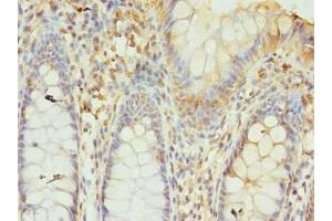 Immunohistochemistry of paraffin-embedded human colon cancer using ABIN7153785 at dilution of 1:100 (GTF3C6 Antikörper  (AA 2-213))