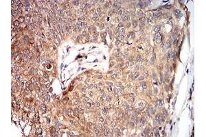Immunohistochemical analysis of paraffin-embedded bladder cancer tissues using VP2 mouse mAb with DAB staining. (VP2 (AA 296-438) Antikörper)