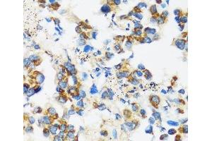 Immunohistochemistry of paraffin-embedded Human lung cancer using APOBEC3F Polyclonal Antibody at dilution of 1:100 (40x lens). (APOBEC3F Antikörper)