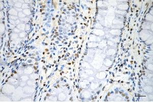 Immunohistochemistry was performed on paraffin-embedded human sigmoid colon carcinoma using phospho-histone H3 (S28) antibody (ABIN7798976), 1:200). (Rekombinanter Histone 3 Antikörper  (H3S28ph))