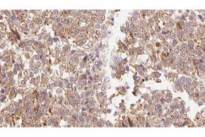 ABIN6278899 at 1/100 staining Human Melanoma tissue by IHC-P. (IL-3 Antikörper  (Internal Region))