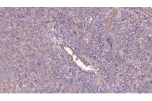 ABIN6273064 at 1/100 staining Human lymph cancer tissue by IHC-P. (PHGDH Antikörper  (N-Term))