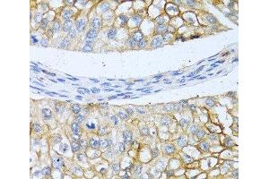 Immunohistochemistry of paraffin-embedded Human prostate cancer using BMP4 Polyclonal Antibody at dilution of 1:100 (40x lens). (BMP4 Antikörper)
