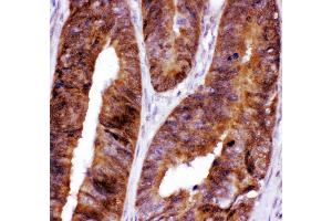 Anti- FOXO3A antibody,IHC(P) IHC(P): Human Intestinal Cancer Tissue (FOXO3 Antikörper  (AA 471-673))