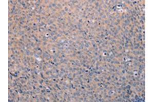 The image on the left is immunohistochemistry of paraffin-embedded Human cervical cancer tissue using ABIN7189808(ANKRD26 Antibody) at dilution 1/25, on the right is treated with synthetic peptide. (ANKRD26 Antikörper)