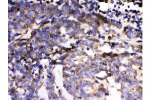 Anti- MAPK6 Picoband antibody, IHC(P) IHC(P): Human Lung Cancer Tissue (MAPK6 Antikörper  (AA 520-721))