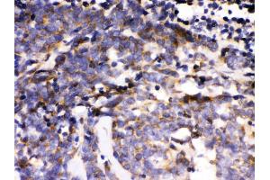 Anti- MAPK6 Picoband antibody, IHC(P) IHC(P): Human Lung Cancer Tissue