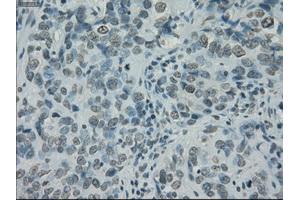 Immunohistochemical staining of paraffin-embedded Carcinoma of thyroid tissue using anti-PRKYmouse monoclonal antibody. (PRKY Antikörper)