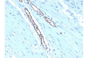 Formalin-fixed, paraffin-embedded human Colon Carcinoma stained with Blood Group Antigen A Monoclonal Antibody (HE-193) (ABO Antikörper)