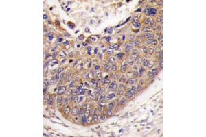 Formalin-fixed and paraffin-embedded human lung carcinoma tissue reacted with FXN antibody , which was peroxidase-conjugated to the secondary antibody, followed by DAB staining. (Frataxin Antikörper  (C-Term))