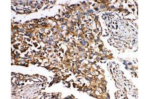 IHC-P: SMAD5 antibody testing of human lung cancer tissue (SMAD5 Antikörper  (Middle Region))