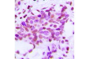 Immunohistochemical analysis of Hexokinase 1 staining in human breast cancer formalin fixed paraffin embedded tissue section. (Hexokinase 1 Antikörper  (N-Term))