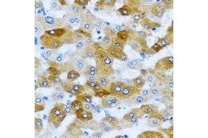 Immunohistochemical analysis of KLK10 staining in human liver cancer formalin fixed paraffin embedded tissue section. (Kallikrein 10 Antikörper)