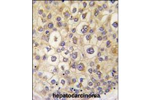 Formalin-fixed and paraffin-embedded human hepatocarcinoma tissue reacted with ARHE antibody , which was peroxidase-conjugated to the secondary antibody, followed by DAB staining. (RND3 Antikörper  (AA 133-165))