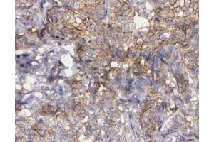 ABIN6268685 at 1/100 staining human lung carcinoma tissue sections by IHC-P. (CD9 Antikörper  (Internal Region))