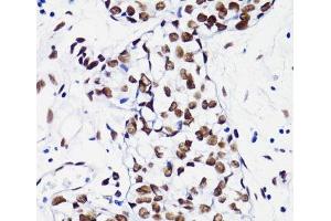Immunohistochemistry of paraffin-embedded Human breast using Acetyl-Histone H4-K8 Polyclonal Antibody at dilution of 1:100 (40x lens). (Histone H4 Antikörper  (acLys8))
