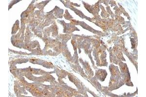 Formalin-fixed, paraffin-embedded human ovarian carcinoma stained with GnRH Receptor antibody (F1G4) (GNRHR Antikörper  (AA 1-29))