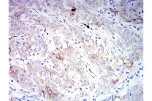 Immunohistochemical analysis of paraffin-embedded cervical cancer tissues using CD66A mouse mAb with DAB staining. (CEACAM1 Antikörper  (AA 65-201))
