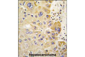 Formalin-fixed and paraffin-embedded human hepatocellular carcinoma reacted with ALDH2 polyclonal antibody  , which was peroxidase-conjugated to the secondary antibody, followed by DAB staining. (ALDH2 Antikörper  (Internal Region))
