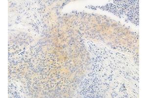 ABIN6263140 and ABIN6266983 at 1/100 staining human gastric carcinoma by IHC-P. (MAST4 Antikörper  (N-Term))