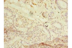 Immunohistochemistry of paraffin-embedded human breast cancer using ABIN7168022 at dilution of 1:100 (RHOC Antikörper  (AA 1-190))