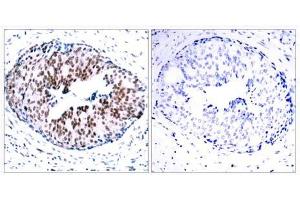 Immunohistochemical analysis of paraffin- embedded human breast carcinoma tissue using STAT5A (phospho-Ser780) antibody (E011049). (STAT5A Antikörper  (pSer780))